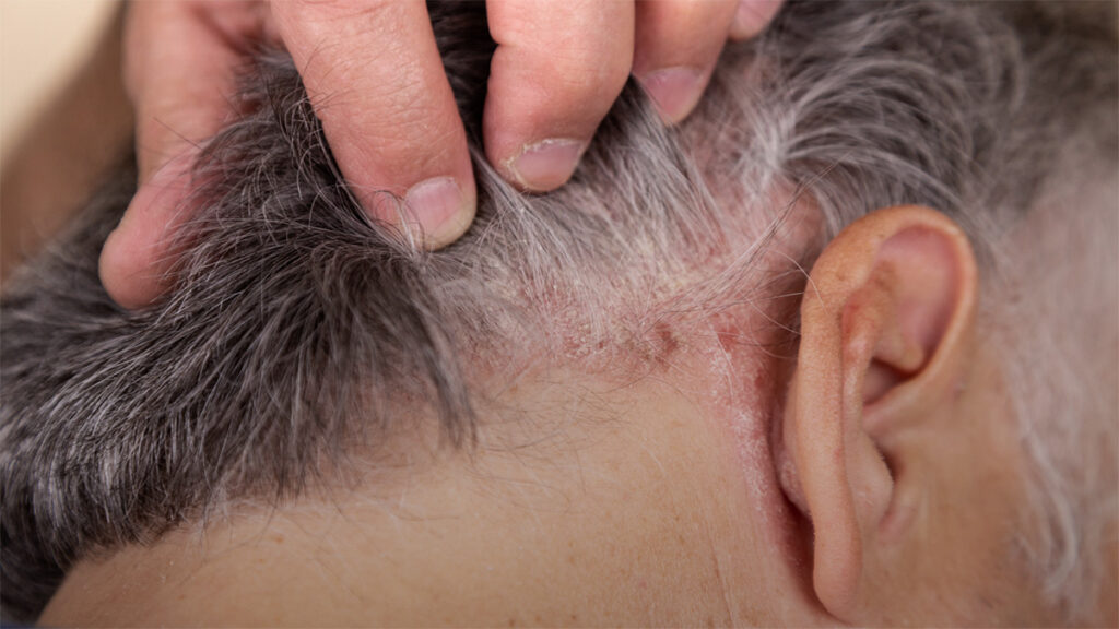 hair loss and skin diseases – causes and connections