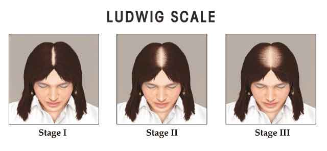 Women Hairloss Ludwig Scale