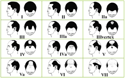 norwood scale