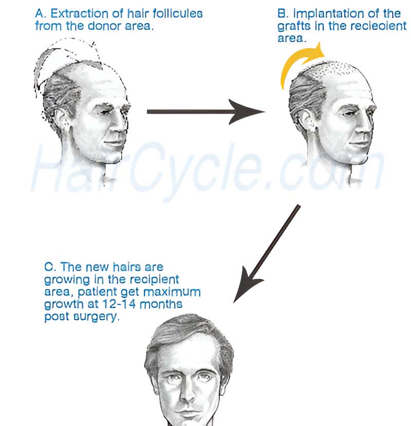 Men bald pattern hair growth