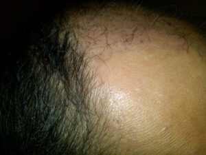 hair transplant healing using haircyle