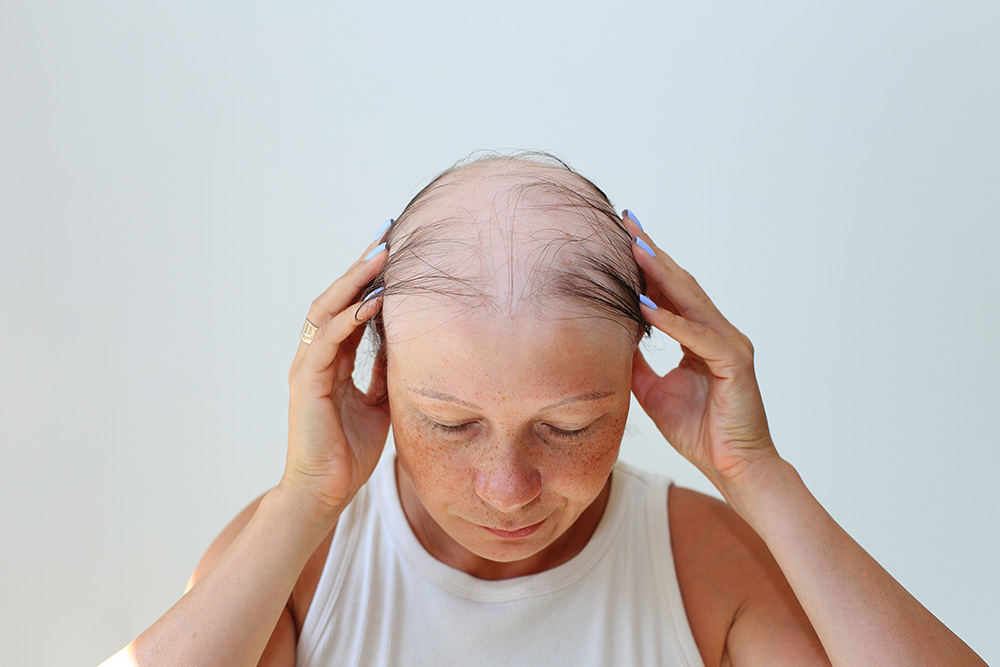 Women hair loss