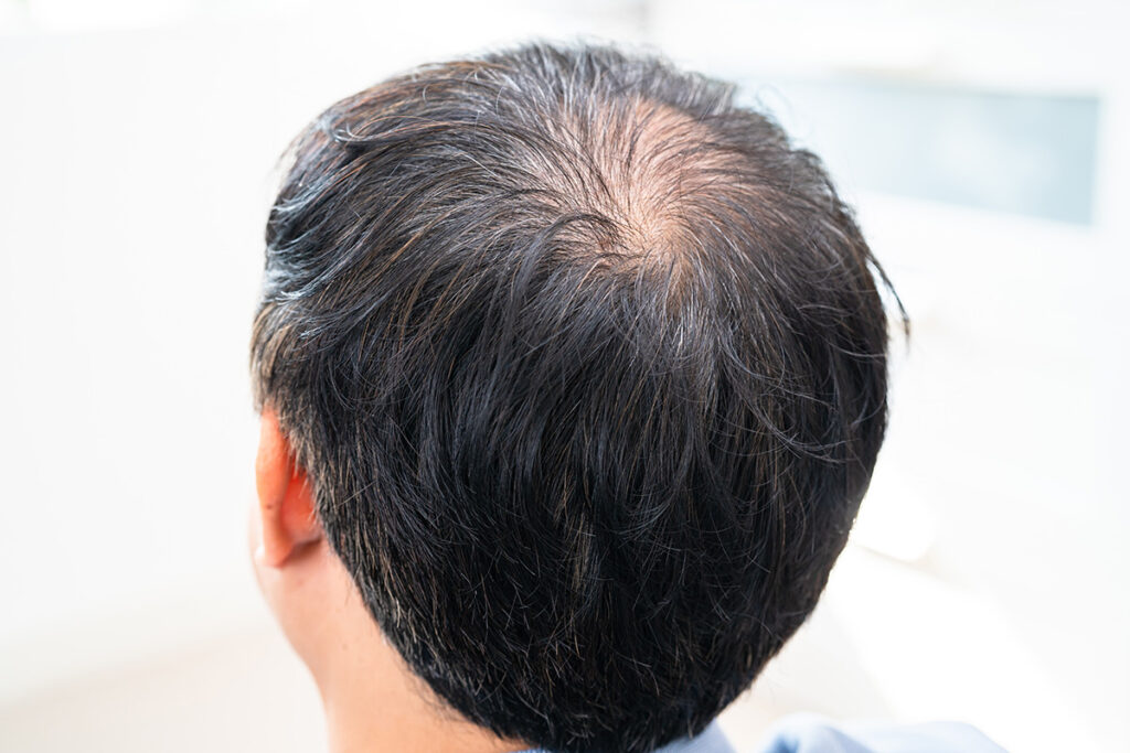 hair thinning man, bald spot